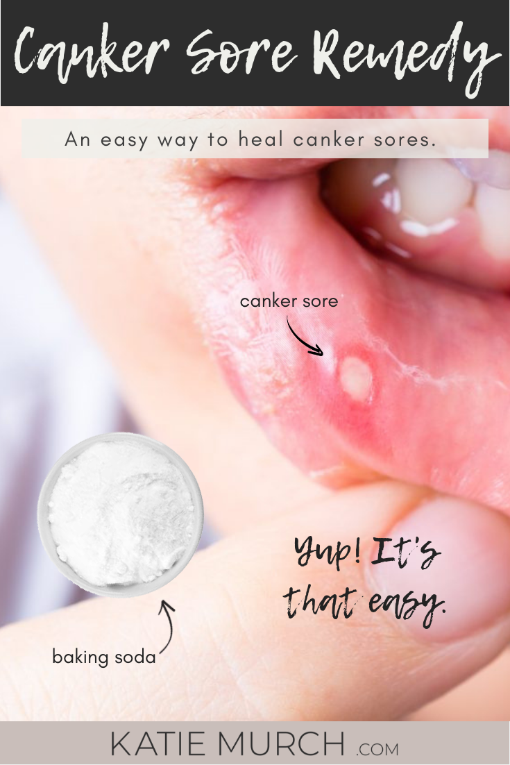 How to prevent a canker sore